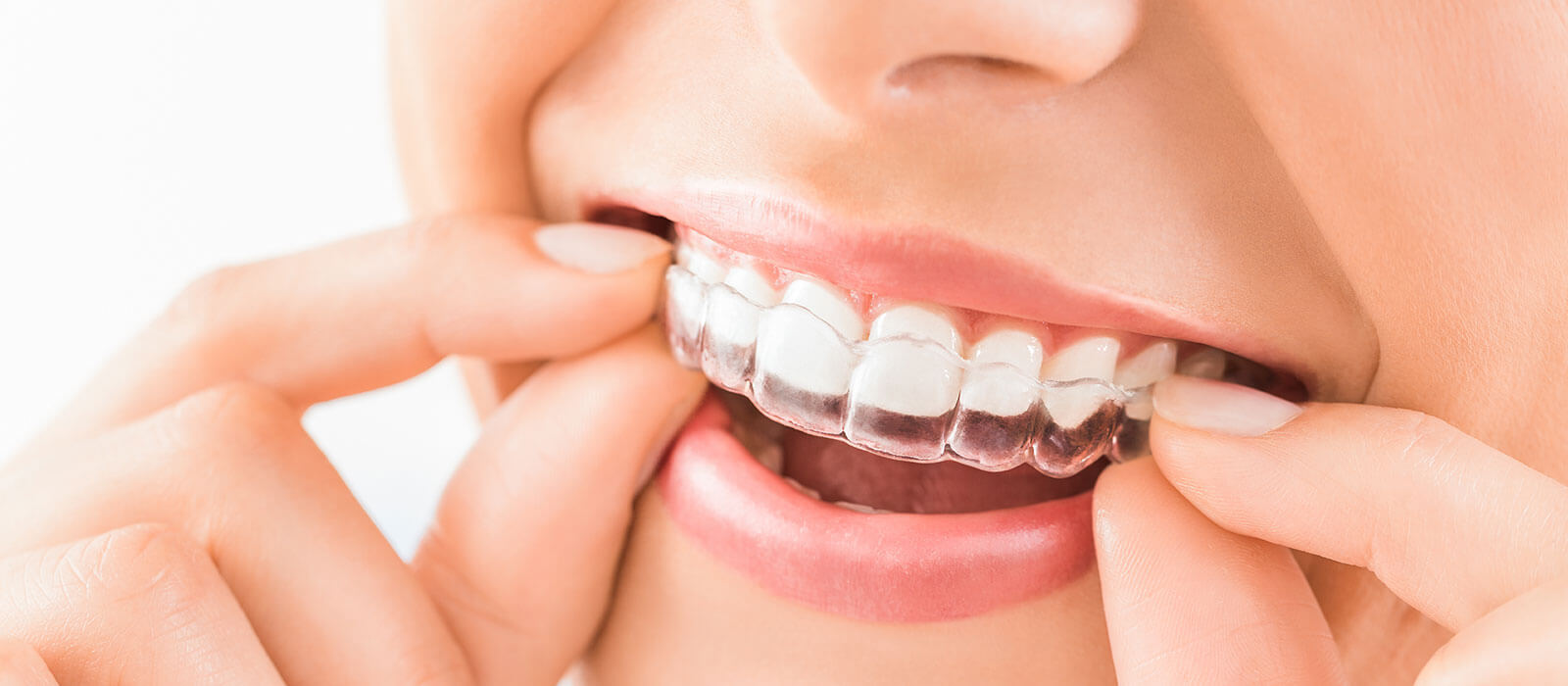 invisalign teeth straightening braces