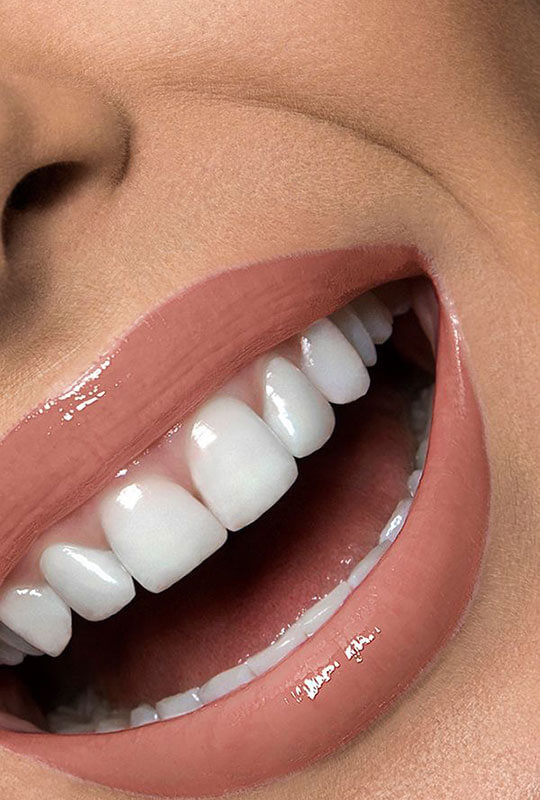 woman smiling with dental veneers 